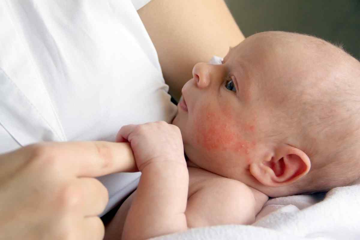 Як лікувати алергію у немовляти