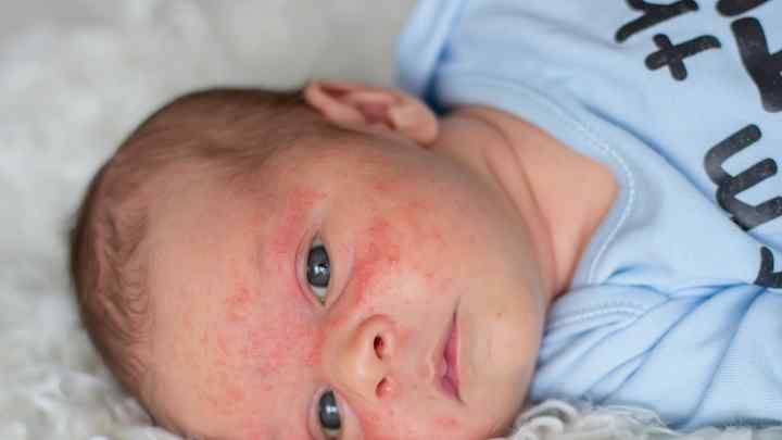 Пеленковий дерматит у дітей: як виглядає, профілактика, лікування
