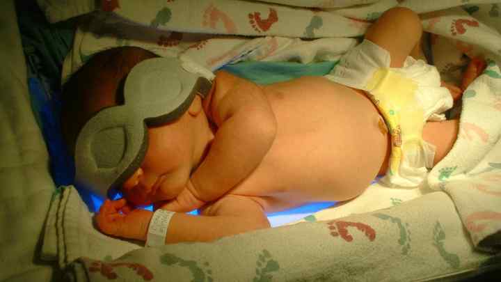 Як лікувати жовтяницю у новонароджених