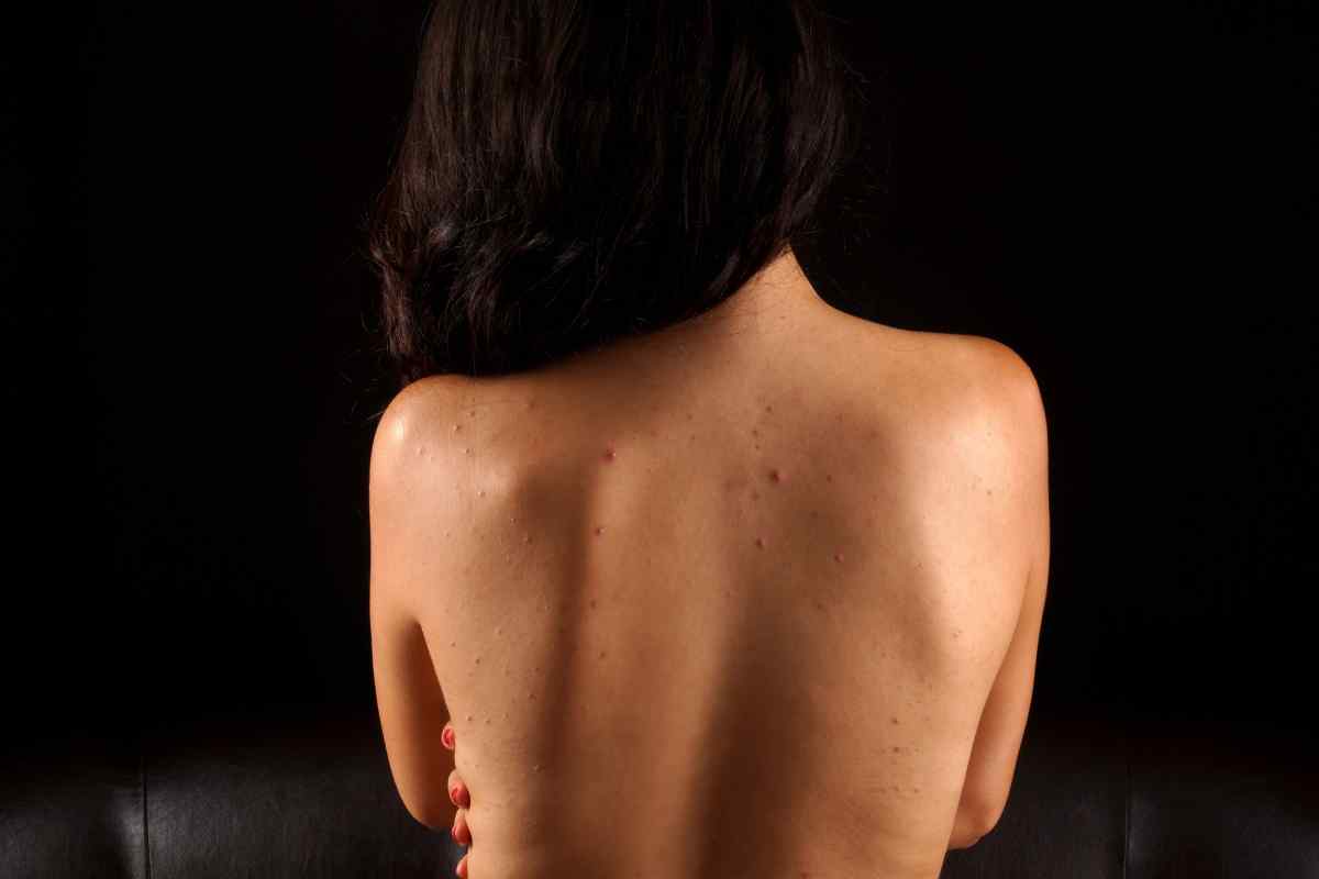 Як позбутися прищів на спині і плечах