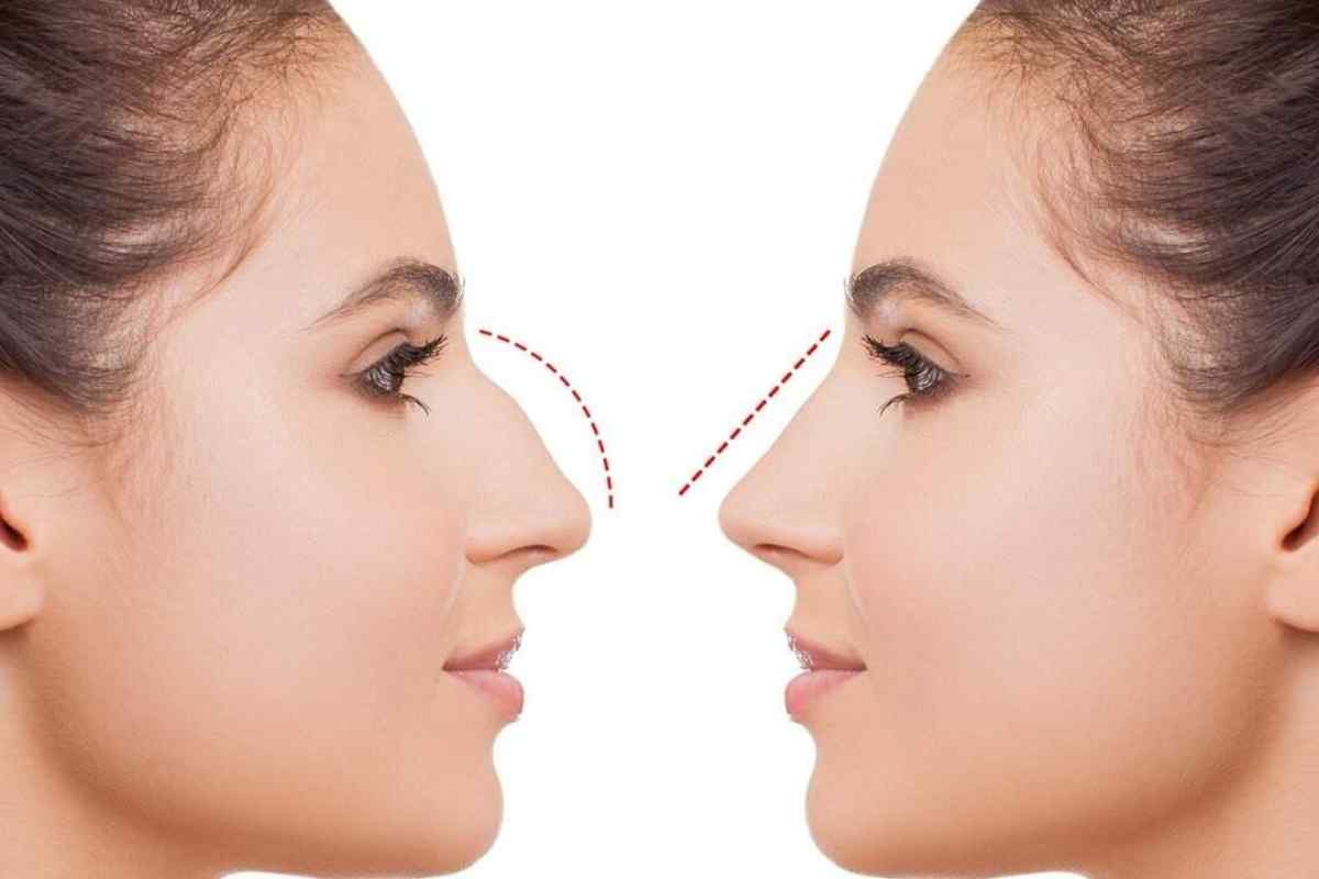 Як можна виправити ніс