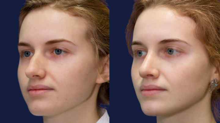Пластична хірургія: зменшення кінчика носа