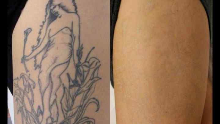 Як безпечно і без шрамів звести татуювання