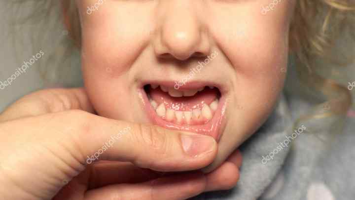 Чому у маленької дитини псуються зуби
