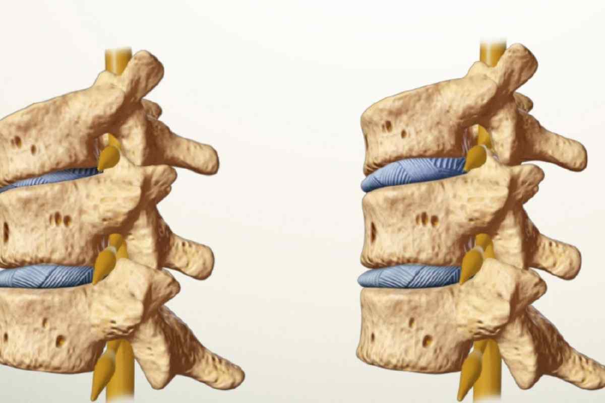 Спондилолістез шийного відділу хребта - опис, симптоми та особливості лікування