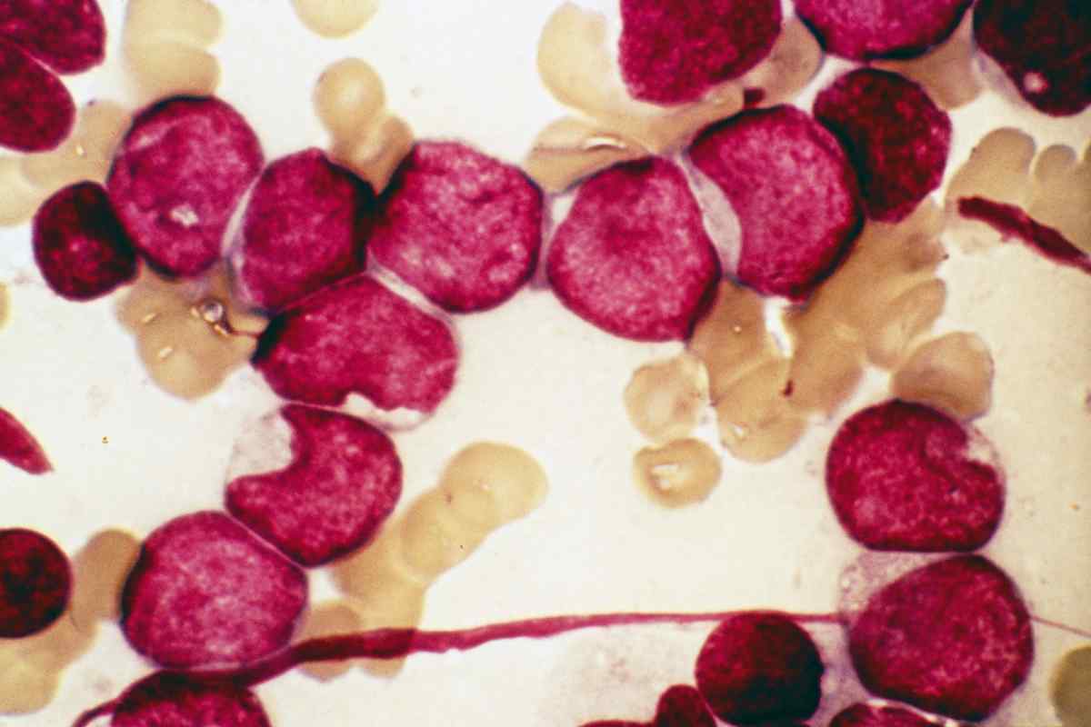 Гемофілія: опис хвороби. Незвертованість крові: причини, симптоми та лікування