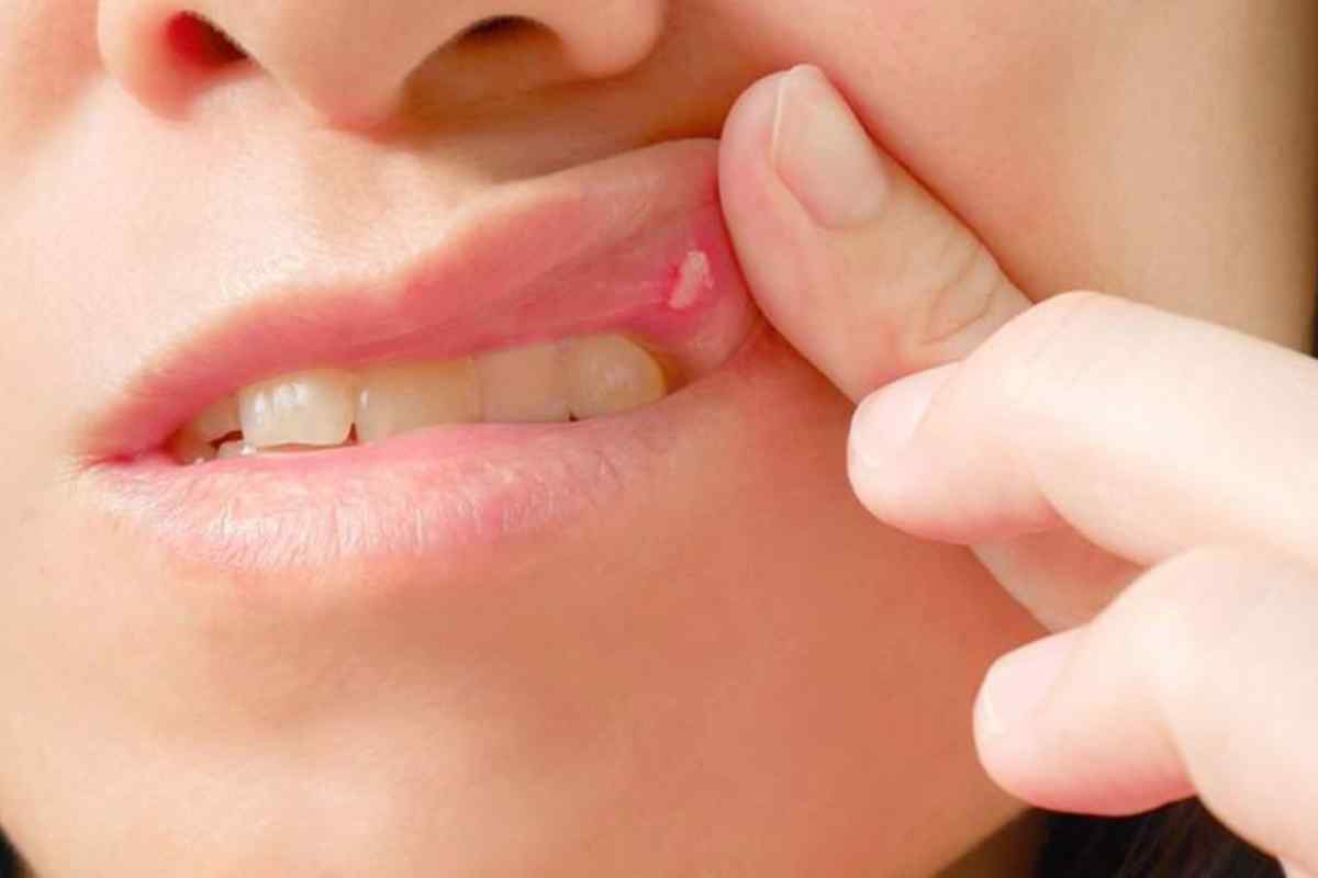 Молочниця в роті у дорослих: симптоми, причини та лікування