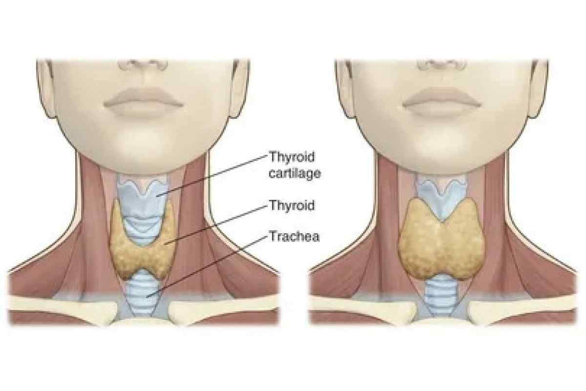 Изменение щитовидной железы у ребенка. Щитовидный хрящ и щитовидка. Кадык и щитовидная железа. Диффузный эутиреоидный зоб.
