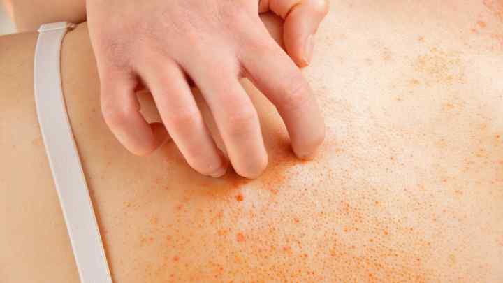 Абсцес шкіри - причини, симптоми, діагностика та лікування