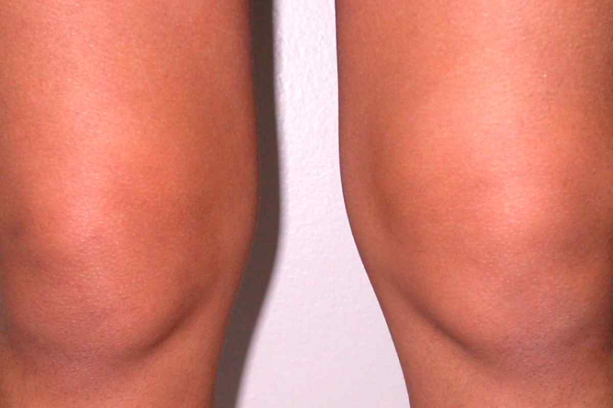 Менісцит колінного суглоба: причини, симптоми та лікування