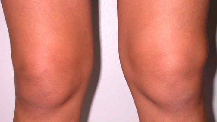 Менісцит колінного суглоба: причини, симптоми та лікування