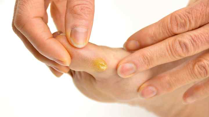 Бородавки на пальцях ніг: лікування лікарськими препаратами. Як вивести бородавку