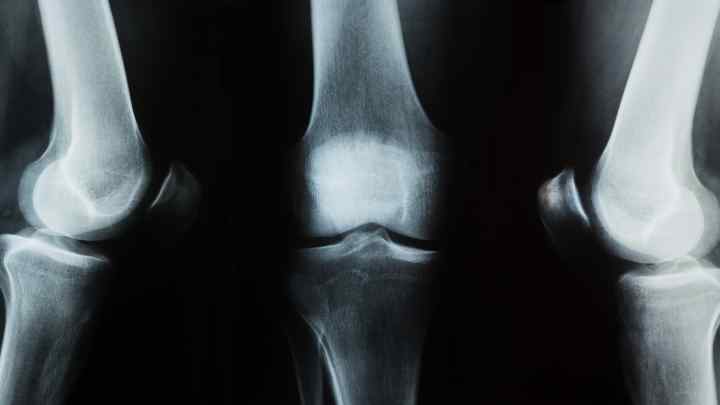 Меніски колінного суглоба: ушкодження та лікування