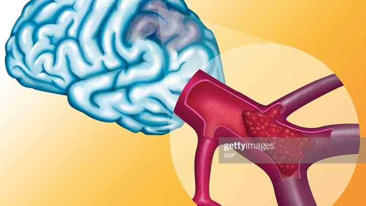 Церебральний атеросклероз судин головного мозку: лікування, причини, діагностика, наслідки хвороби