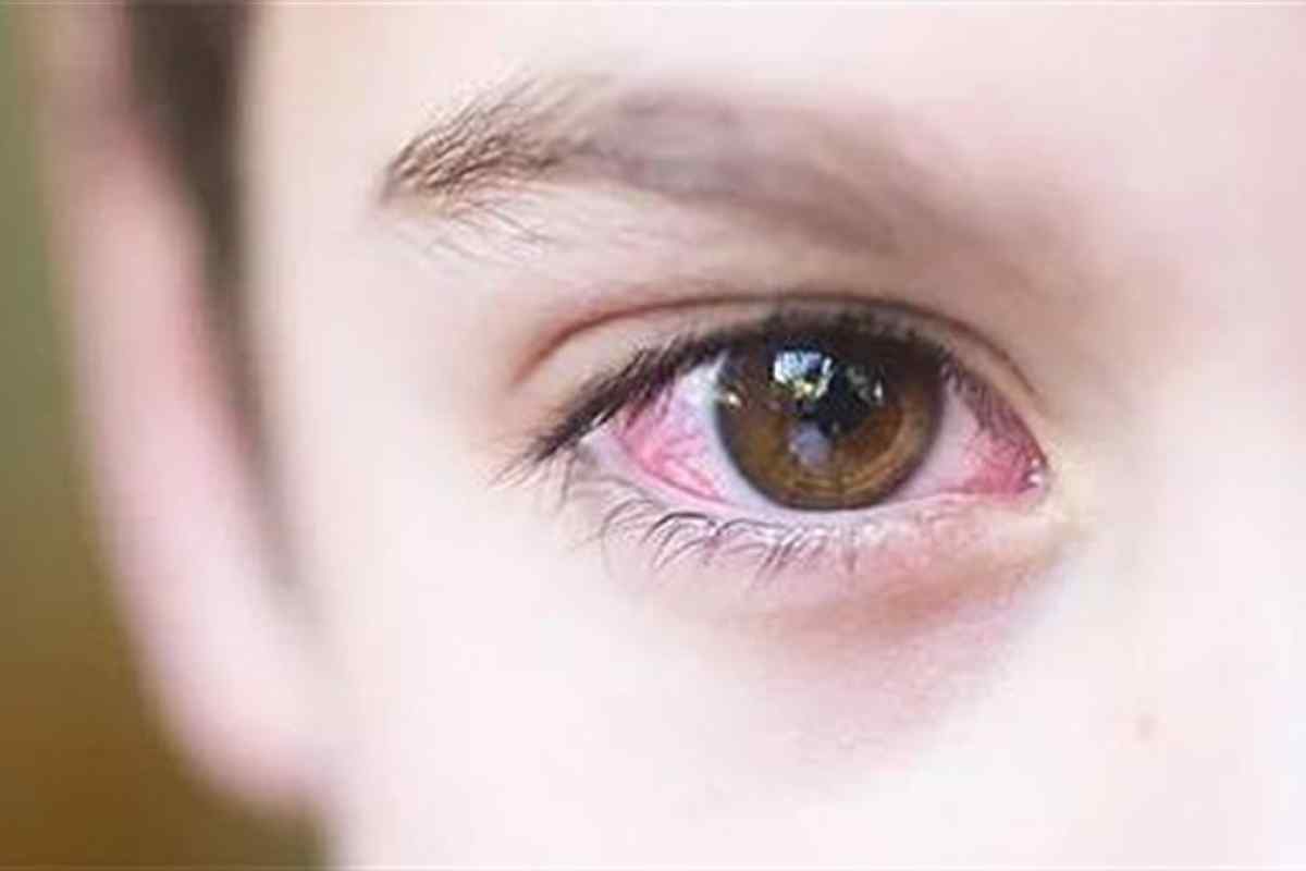 Почервоніння очного яблука: причини та лікування