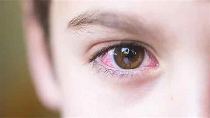 Почервоніння очного яблука: причини та лікування