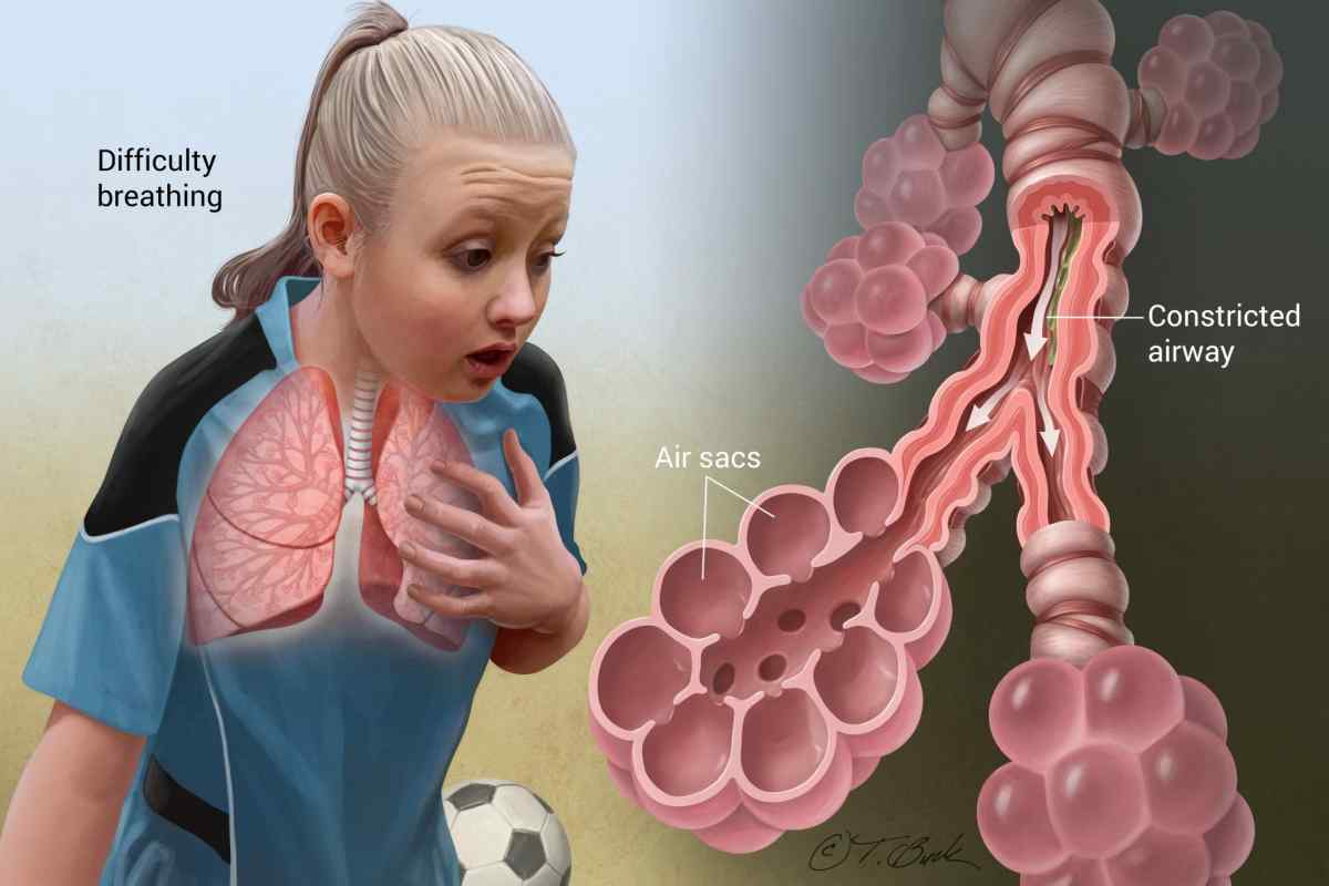 Ендогенна бронхіальна астма: симптоми, діагностика та лікування