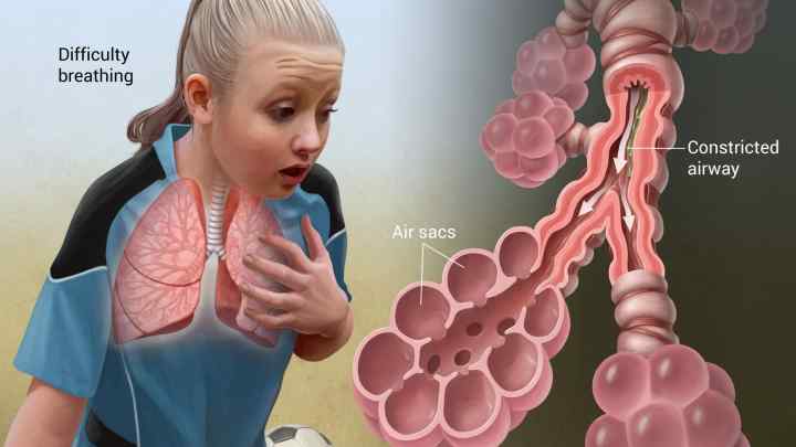 Ендогенна бронхіальна астма: симптоми, діагностика та лікування