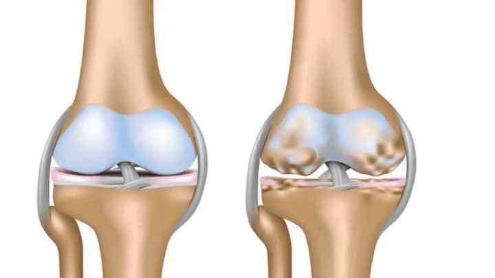 Вивих колінного суглоба: основні симптоми, лікування