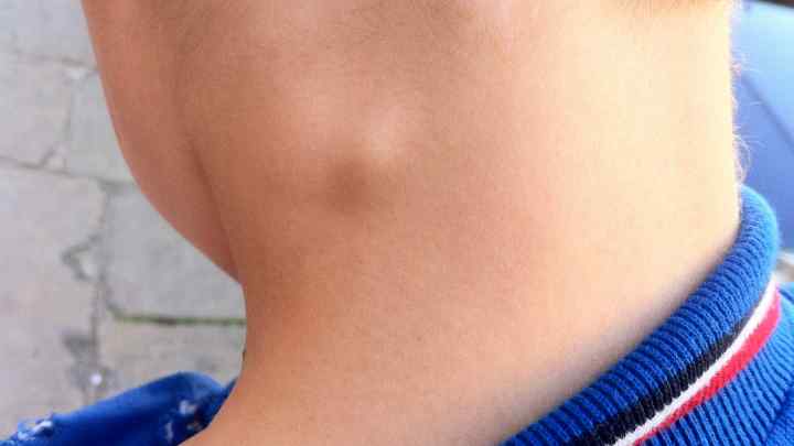 Збільшені лімфовузли в черевній порожнині у дитини: причини та лікування