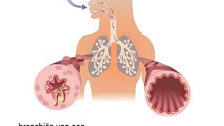 Чи можна померти від астми: особливості хвороби, можливі причини та способи лікування