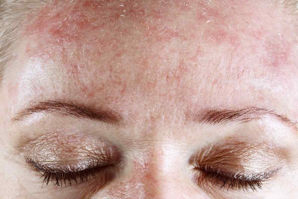 Дерматит шкіри голови: причини, симптоми та лікування народними засобами і препаратами