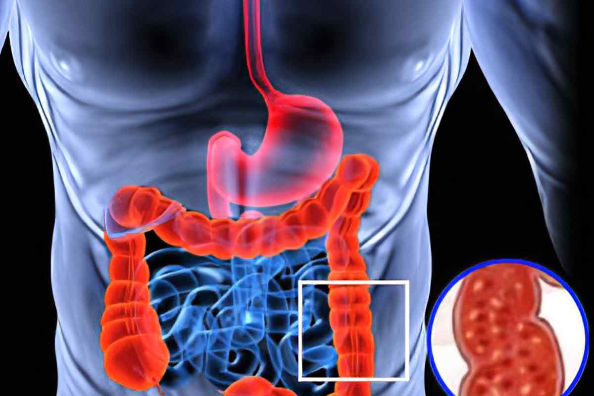 Синдром дірявого кишечника: симптоми і лікування