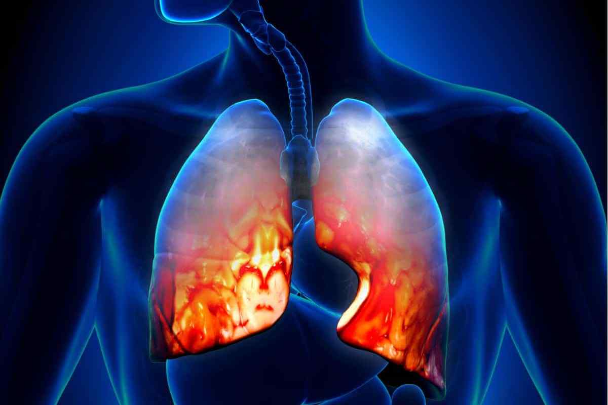 Чи можна курити при пневмонії: шкода від нікотину для організму, труднощі лікування і наслідки для легенів, відновний період і профілактика