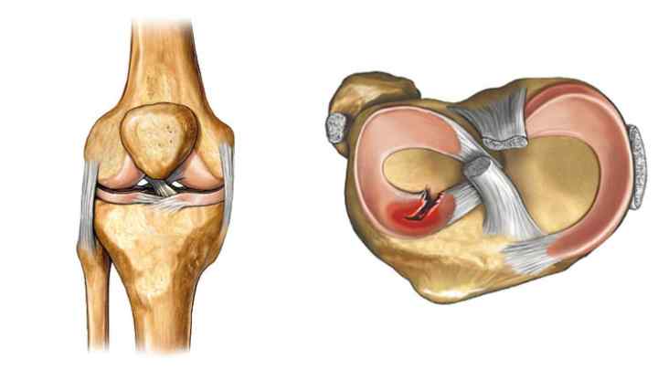 Операція на колінному суглобі на меніску, відновлення
