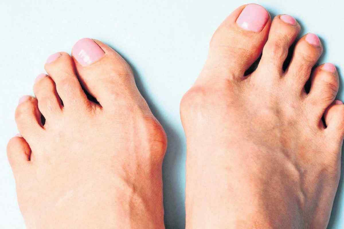 Як і чому виникають шишки на пальцях ніг