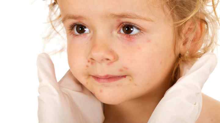 Як лікувати герпесну ангіну у дітей?