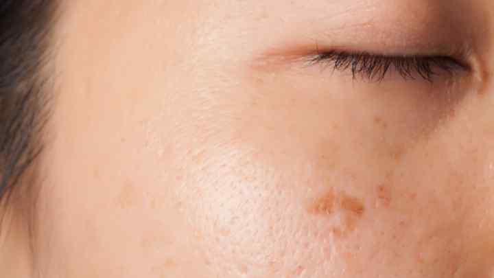 На шкірі плями світло-коричневого кольору: причини та лікування
