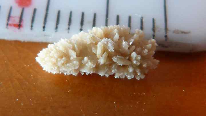Коралоподібний камінь у нирці: лікування та наслідки