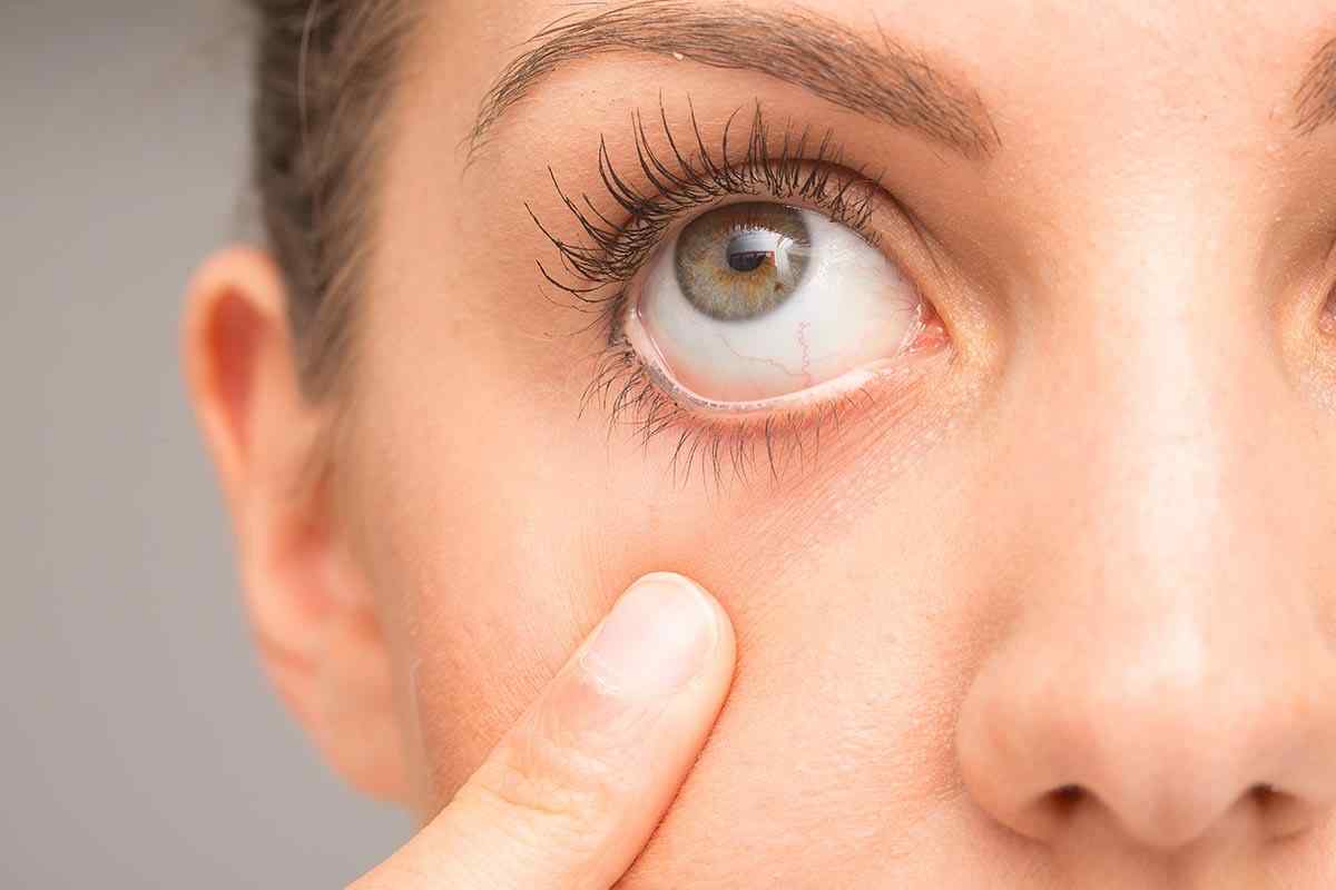 Жовтизна навколо очей: причини та лікування