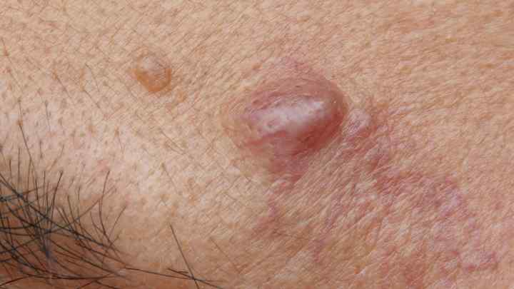 Карбункул - це гостре гнійно-некротичне запалення шкіри: причини, лікування, профілактика