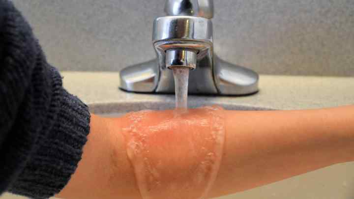 Хімічний опік шкіри: лікування в домашніх умовах
