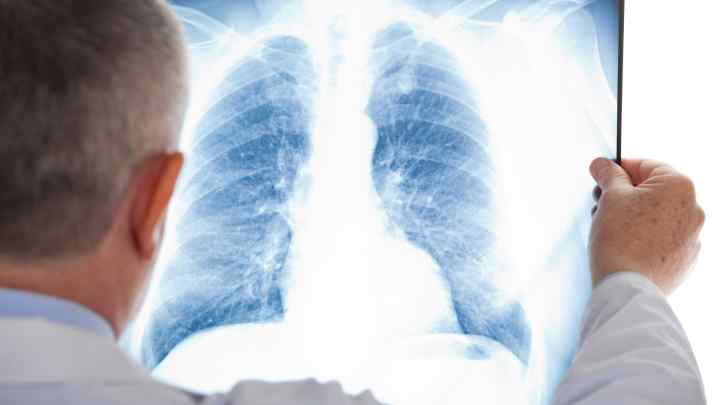 Попкорнова хвороба легенів: симптоми, лікування, причини виникнення