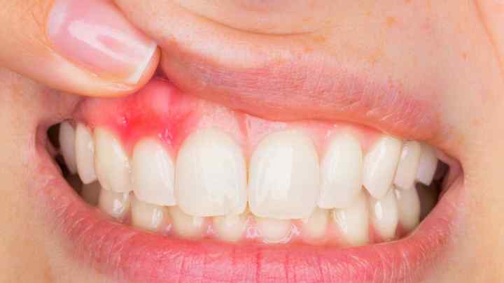 Ретінований зуб: що це? Симптоматика, ризики та способи лікування