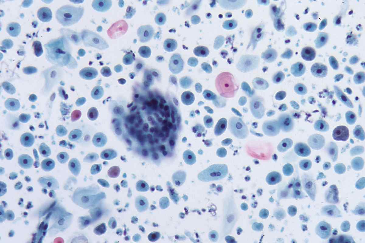 Підвищені лейкоцити в мазку на флору у жінок