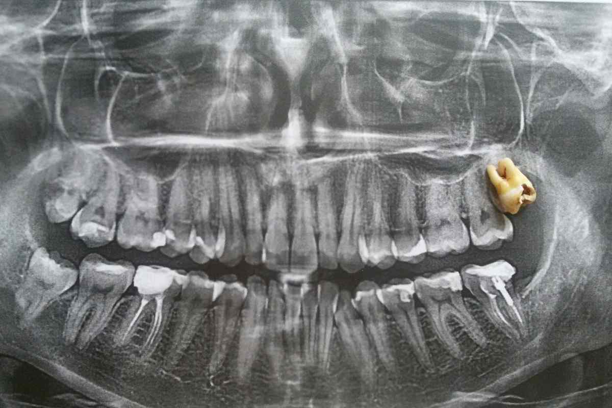 Чи можна робити МРТ з імплантами зубів? Показання для призначення і наслідки діагностики