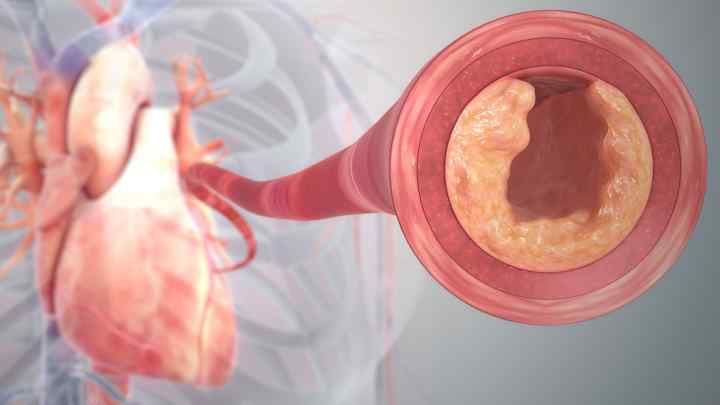 Атеросклеротичний кардіосклероз: причини, симптоми та лікування