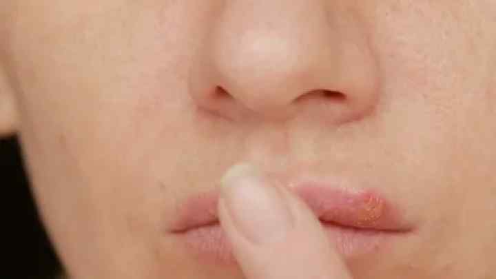 Герпес у носі: основні симптоми і як з ними впоратися