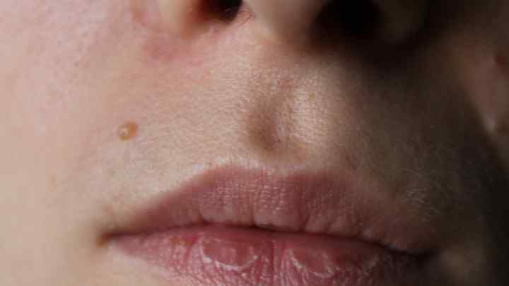 Розбили губу: що робити і як зняти пухлину?