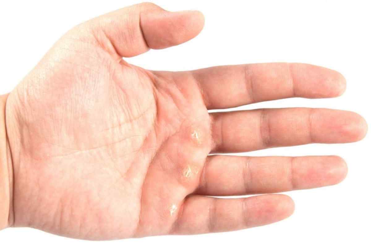 Лікування мозолів на пальцях ніг у домашніх умовах