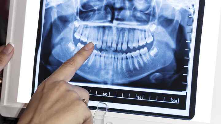 Як роблять рентген зуба? Чи шкідливо робити рентген зубів при вагітності?