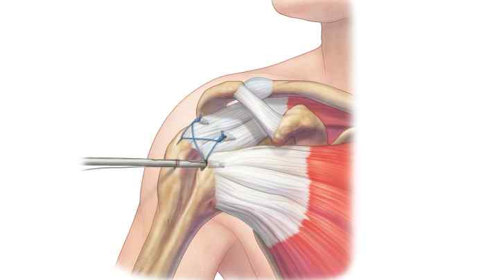 Обертальна манжета плеча: будова, функції, можливі захворювання і травми