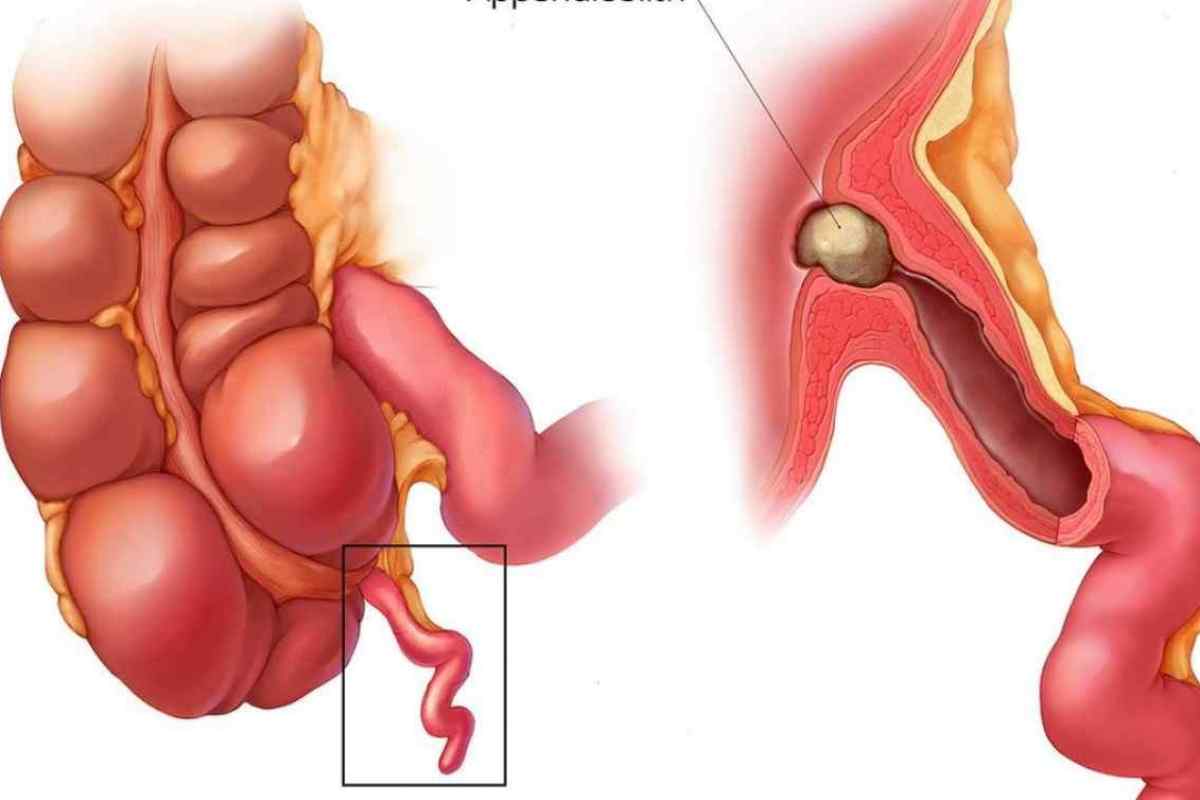 Апендицит з перитонітом: операція з вилучення і наслідки