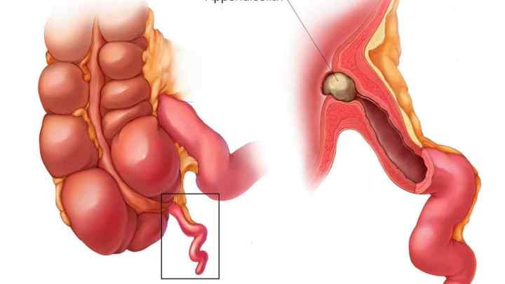 Апендицит з перитонітом: операція з вилучення і наслідки