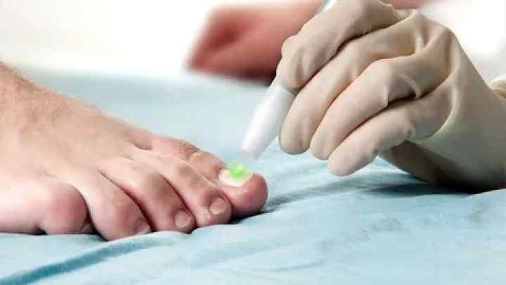Що робити з врослим нігтем на нозі: симптоми, причини, традиційне лікування, домашні методи і профілактика