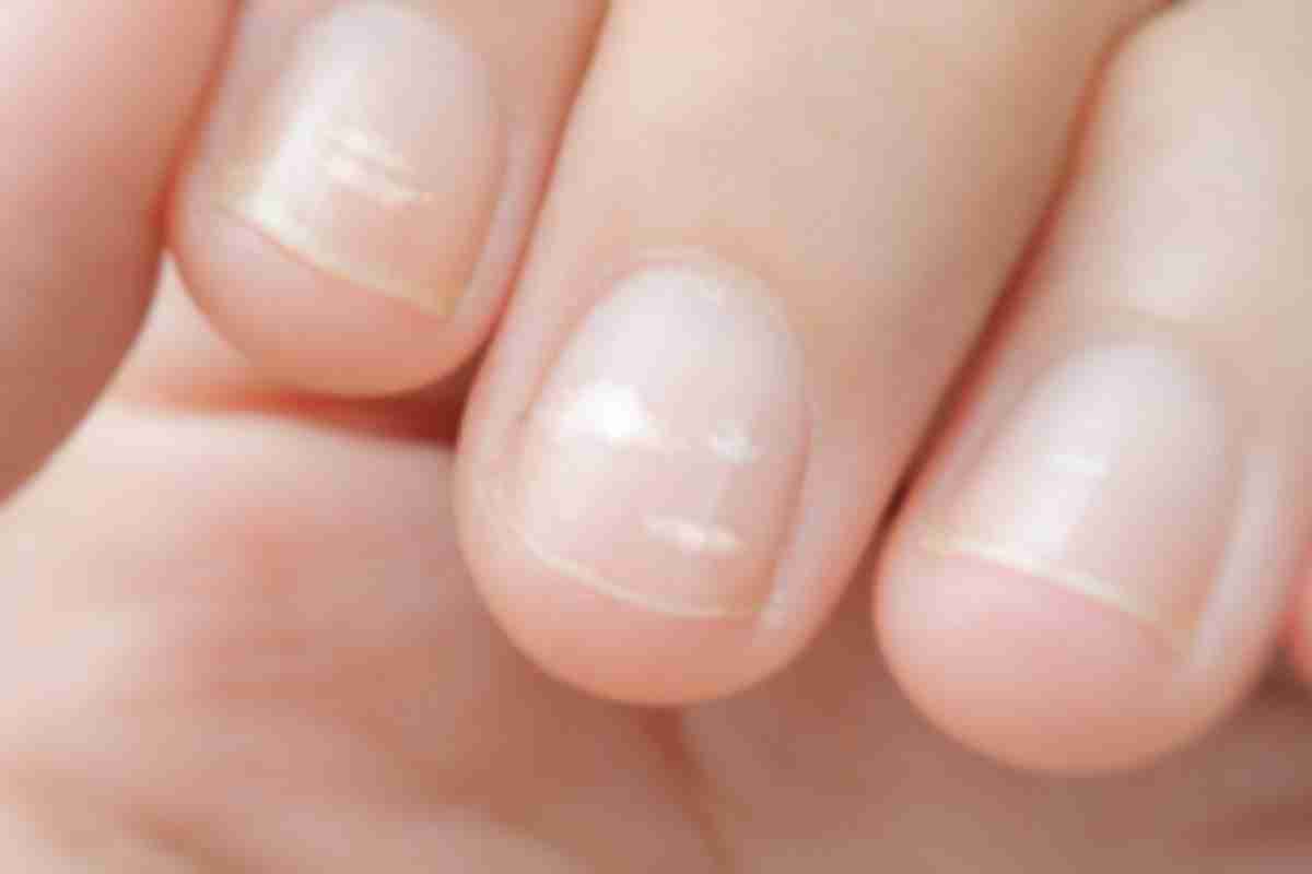 Причина білих плям на нігтях: способи позбавлення